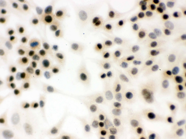 NBN / Nibrin Antibody - IHC analysis of p95 NBS1 using anti-p95 NBS1 antibody. p95 NBS1 was detected in immunocytochemical section of A549 cell. Heat mediated antigen retrieval was performed in citrate buffer (pH6, epitope retrieval solution) for 20 mins. The tissue section was blocked with 10% goat serum. The tissue section was then incubated with 1µg/ml rabbit anti-p95 NBS1 Antibody overnight at 4°C. Biotinylated goat anti-rabbit IgG was used as secondary antibody and incubated for 30 minutes at 37°C. The tissue section was developed using Strepavidin-Biotin-Complex (SABC) with DAB as the chromogen.