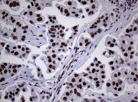 NBN / Nibrin Antibody - IHC of paraffin-embedded Carcinoma of Human bladder tissue using anti-NBN mouse monoclonal antibody.