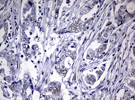 NBN / Nibrin Antibody - IHC of paraffin-embedded Adenocarcinoma of Human breast tissue using anti-NBN mouse monoclonal antibody.