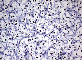 NBN / Nibrin Antibody - IHC of paraffin-embedded Carcinoma of Human kidney tissue using anti-NBN mouse monoclonal antibody.