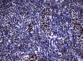 NBN / Nibrin Antibody - IHC of paraffin-embedded Human lymphoma tissue using anti-NBN mouse monoclonal antibody.