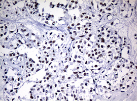 NBN / Nibrin Antibody - IHC of paraffin-embedded Carcinoma of Human pancreas tissue using anti-NBN mouse monoclonal antibody.