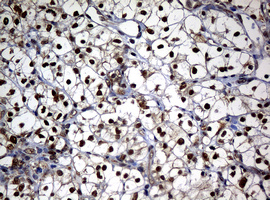 NBN / Nibrin Antibody - IHC of paraffin-embedded Carcinoma of Human kidney tissue using anti-NBN mouse monoclonal antibody.