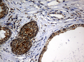 NBN / Nibrin Antibody - IHC of paraffin-embedded Carcinoma of Human prostate tissue using anti-NBN mouse monoclonal antibody.