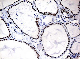 NBN / Nibrin Antibody - IHC of paraffin-embedded Human thyroid tissue using anti-NBN mouse monoclonal antibody.