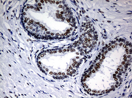 NBN / Nibrin Antibody - IHC of paraffin-embedded Carcinoma of Human prostate tissue using anti-NBN mouse monoclonal antibody.