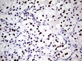 NBN / Nibrin Antibody - IHC of paraffin-embedded Carcinoma of Human kidney tissue using anti-NBN mouse monoclonal antibody.