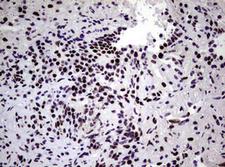 NBN / Nibrin Antibody - IHC of paraffin-embedded Carcinoma of Human lung tissue using anti-NBN mouse monoclonal antibody.