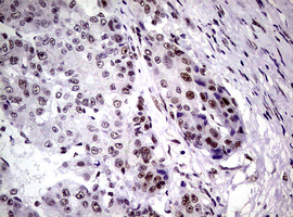 NBN / Nibrin Antibody - IHC of paraffin-embedded Carcinoma of Human liver tissue using anti-NBN mouse monoclonal antibody.