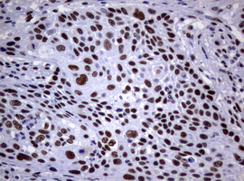NBN / Nibrin Antibody - IHC of paraffin-embedded Carcinoma of Human lung tissue using anti-NBN mouse monoclonal antibody.