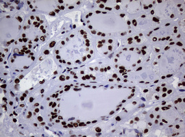NBN / Nibrin Antibody - IHC of paraffin-embedded Carcinoma of Human thyroid tissue using anti-NBN mouse monoclonal antibody.