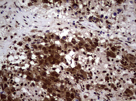 NBN / Nibrin Antibody - IHC of paraffin-embedded Adenocarcinoma of Human ovary tissue using anti-NBN mouse monoclonal antibody.