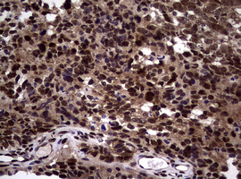NBN / Nibrin Antibody - IHC of paraffin-embedded Adenocarcinoma of Human endometrium tissue using anti-NBN mouse monoclonal antibody.