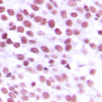 NBN / Nibrin Antibody - Immunohistochemical analysis of Nibrin staining in human breast cancer formalin fixed paraffin embedded tissue section. The section was pre-treated using heat mediated antigen retrieval with sodium citrate buffer (pH 6.0). The section was then incubated with the antibody at room temperature and detected using an HRP conjugated compact polymer system. DAB was used as the chromogen. The section was then counterstained with hematoxylin and mounted with DPX.