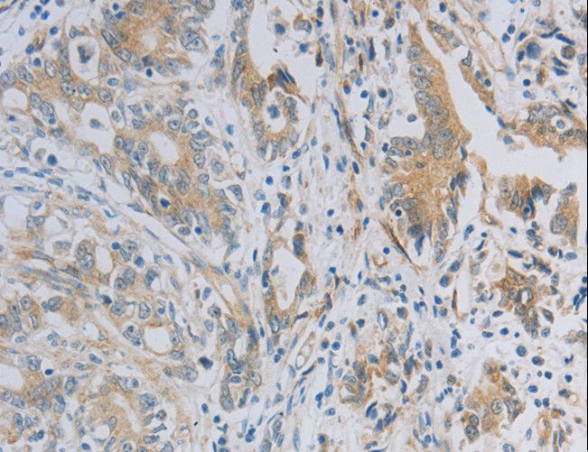 NBN / Nibrin Antibody - Immunohistochemistry of paraffin-embedded Human gastric cancer using NBN Polyclonal Antibody at dilution of 1:50.
