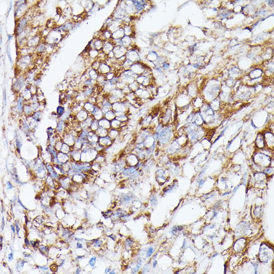 NBP / NUBP1 Antibody - Immunohistochemistry of paraffin-embedded Human colon carcinoma using NUBP1 Polyclonal Antibody at dilution of 1:100 (40x lens).