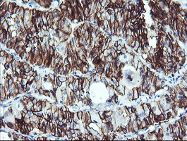 NCAM / CD56 Antibody - IHC of paraffin-embedded Carcinoma of Human thyroid tissue using anti-NCAM1 mouse monoclonal antibody. (Heat-induced epitope retrieval by 10mM citric buffer, pH6.0, 120°C for 3min).