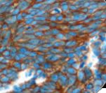 NCAM / CD56 Antibody - IHC of CD56 on FFPE Neuroblastoma tissue. This image was taken for the unmodified form of this product. Other forms have not been tested.