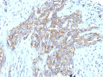 NCAM / CD56 Antibody - IHC staining of FFPE human lung carcinoma with CD56 antibody (clone 56C04 + 123C.D5). HIER: boil tissue sections in pH6, 10mM citrate buffer, for 10-20 min followed by cooling at RT for 20 min.