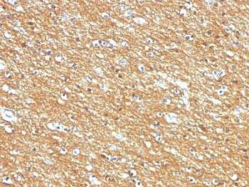 NCAM / CD56 Antibody - IHC staining of FFPE human brain tumor with CD56 antibody (clone 56C04/123A8). HIER: boil tissue sections in pH6, 10mM citrate buffer, for 10-20 min followed by cooling at RT for 20 min.