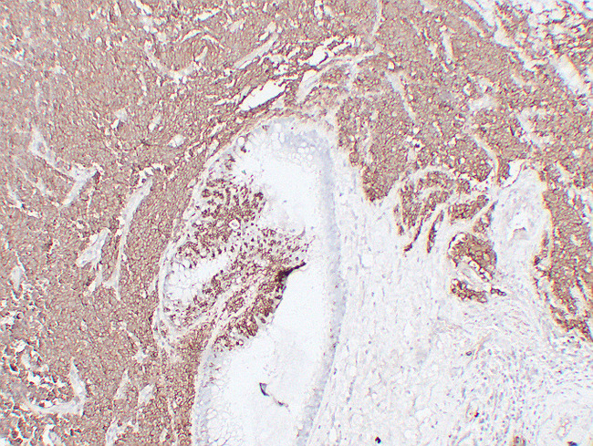 NCAM / CD56 Antibody - Small Cell Lung Carcinoma