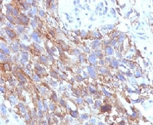 NCAM / CD56 Antibody - IHC testing of FFPE human lung carcinoma with CD56 antibody (clone CDLA56).  This image was taken for the unmodified form of this product. Other forms have not been tested.