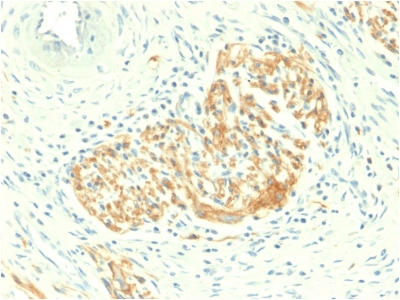 NCAM / CD56 Antibody - Formalin-fixed, paraffin-embedded human Colon Carcinoma stained with CD56 Rabbit Recombinant Monoclonal Antibody (NCAM1/2217R).