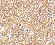 NCAM / CD56 Antibody - Formalin-fixed, paraffin-embedded human brain tumor stained with CD56 antibody.  This image was taken for the unmodified form of this product. Other forms have not been tested.