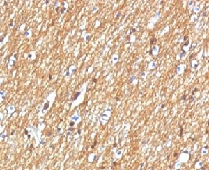NCAM / CD56 Antibody - Formalin-fixed, paraffin-embedded human brain tumor stained with CD56 antibody.  This image was taken for the unmodified form of this product. Other forms have not been tested.