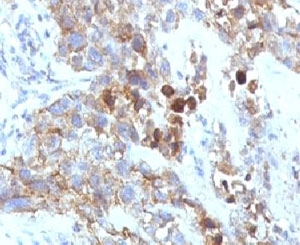 NCAM / CD56 Antibody - Formalin-fixed, paraffin-embedded human lung carcinoma stained with CD56 antibody.  This image was taken for the unmodified form of this product. Other forms have not been tested.