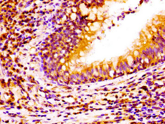 NCAM2 Antibody - Immunohistochemistry image of paraffin-embedded human lung cancer at a dilution of 1:100