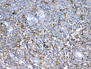 NCAN / Neurocan Antibody - IHC testing of FFPE human glioma tissue with Neurocan antibody at 1ug/ml. Required HIER: steam section in pH6 citrate buffer for 20 min and allow to cool prior to testing.