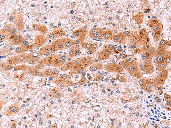 NCAN / Neurocan Antibody - Immunohistochemistry of paraffin-embedded Human liver cancer tissue  using NCAN Polyclonal Antibody at dilution of 1:30(×200)