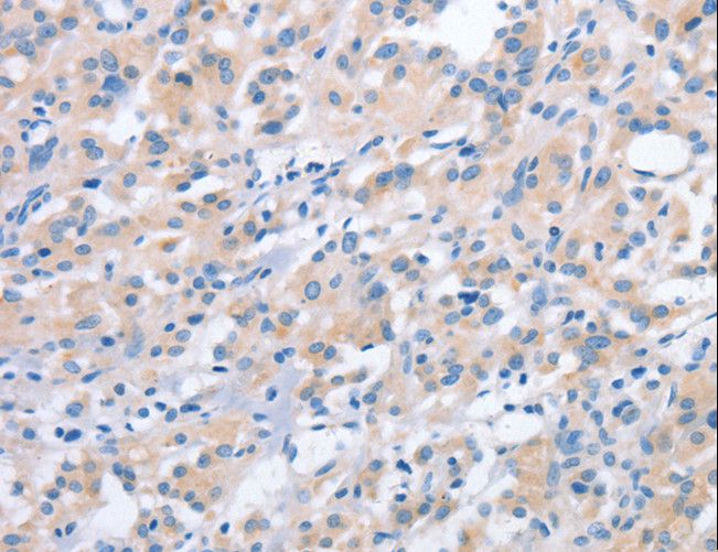 NCAPD2 Antibody - Immunohistochemistry of paraffin-embedded Human thyroid cancer using NCAPD2 Polyclonal Antibody at dilution of 1:40.
