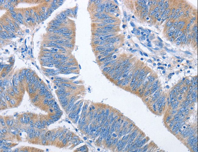 NCAPD2 Antibody - Immunohistochemistry of paraffin-embedded Human colon cancer using NCAPD2 Polyclonal Antibody at dilution of 1:40.