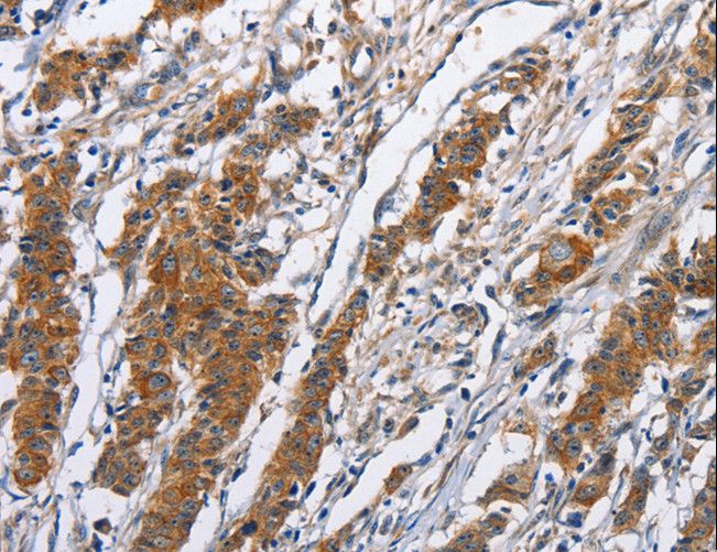 NCAPD3 / HCAP-D3 Antibody - Immunohistochemistry of paraffin-embedded Human thyroid cancer using NCAPD3 Polyclonal Antibody at dilution of 1:50.
