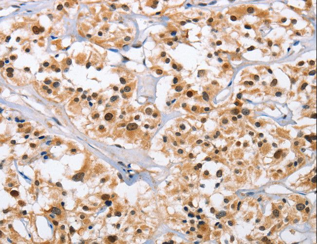 NCAPD3 / HCAP-D3 Antibody - Immunohistochemistry of paraffin-embedded Human thyroid cancer using NCAPD3 Polyclonal Antibody at dilution of 1:50.