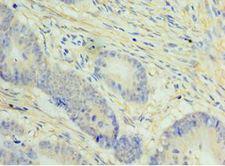 NCAPH / CAP-H Antibody - Immunohistochemistry of paraffin-embedded human colon cancer using antibody at 1:100 dilution.