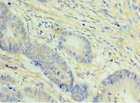NCAPH / CAP-H Antibody - Immunohistochemistry of paraffin-embedded human colon cancer using NCAPH Antibody at dilution of 1:100