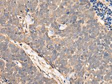 NCAPH / CAP-H Antibody - Immunohistochemistry of paraffin-embedded Human thyroid cancer tissue  using NCAPH Polyclonal Antibody at dilution of 1:45(×200)