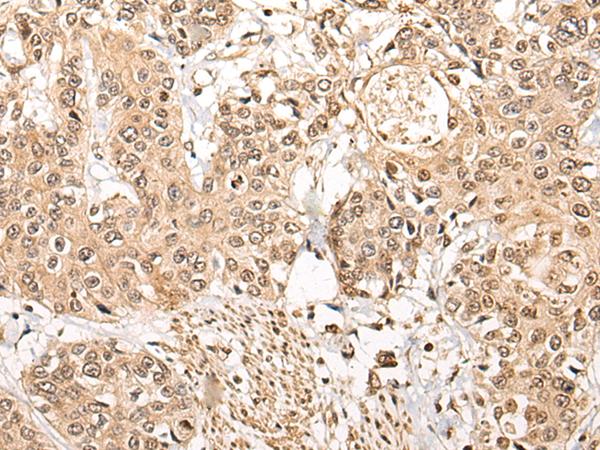 NCAPH / CAP-H Antibody - Immunohistochemistry of paraffin-embedded Human prost ate cancer tissue  using NCAPH Polyclonal Antibody at dilution of 1:45(×200)