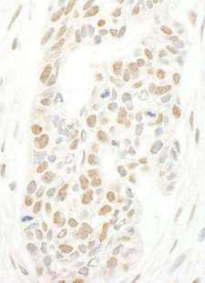 NCAPH2 / CAP-H2 Antibody - Detection of Human CAP-H2 by Immunohistochemistry. Sample: FFPE section of human skin carcinoma. Antibody: Affinity purified rabbit anti-CAP-H2 used at a dilution of 1:250.