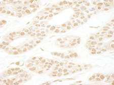 NCAPH2 / CAP-H2 Antibody - Detection of Human CAP-H2 by Immunohistochemistry. Sample: FFPE section of human breast carcinoma. Antibody: Affinity purified rabbit anti-CAP-H2 used at a dilution of 1:1000 (1 ug/ml).