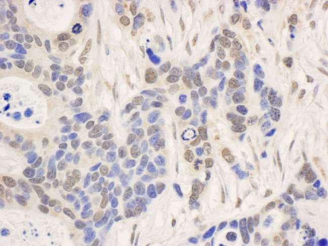 NCBP1 / CBP80 Antibody - Detection of Human NCBP1/CBP80 by Immunohistochemistry. Sample: FFPE section of human ovarian carcinoma. Antibody: Affinity purified rabbit anti-NCBP1/CBP80 used at a dilution of 1:1000 (1 ug/ml). Detection: DAB.