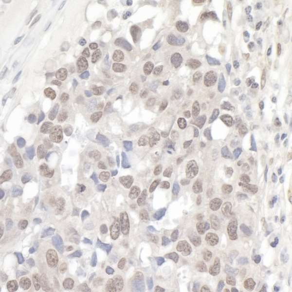 NCBP1 / CBP80 Antibody - Detection of human NCBP1/CBP80 by immunohistochemistry. Sample: FFPE section of human ovarian carcinoma. Antibody: Affinity purified rabbit anti- NCBP1/CBP80 used at a dilution of 1:1,000 (1µg/ml). Detection: DAB