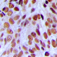 NCBP1 / CBP80 Antibody - Immunohistochemical analysis of CBP80 staining in human breast cancer formalin fixed paraffin embedded tissue section. The section was pre-treated using heat mediated antigen retrieval with sodium citrate buffer (pH 6.0). The section was then incubated with the antibody at room temperature and detected using an HRP polymer system. DAB was used as the chromogen. The section was then counterstained with hematoxylin and mounted with DPX.