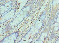 NCBP2 / CBP20 Antibody - Immunohistochemistry of paraffin-embedded human rectal cancer using antibody at 1:100 dilution.