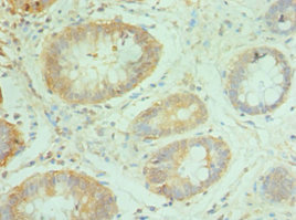NCBP2 / CBP20 Antibody - Immunohistochemistry of paraffin-embedded human colon cancer using NCBP2 Antibody at dilution of 1:100