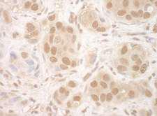 NCBP2 / CBP20 Antibody - Detection of Human NCBP2 by Immunohistochemistry. Sample: FFPE section of human breast carcinoma. Antibody: Affinity purified rabbit anti-NCBP2 used at a dilution of 1:5000 (0.2 ug/ml). Detection: DAB.