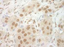 NCBP2 / CBP20 Antibody - Detection of Human NCBP2 by Immunohistochemistry. Sample: FFPE section of human breast carcinoma. Antibody: Affinity purified rabbit anti-NCBP2 used at a dilution of 1:100.